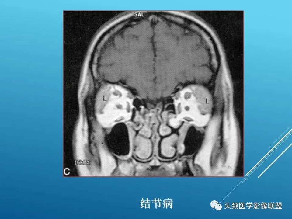 影像PPT - 【PPT】泪腺肿瘤及肿瘤样病变的影像学诊断-52