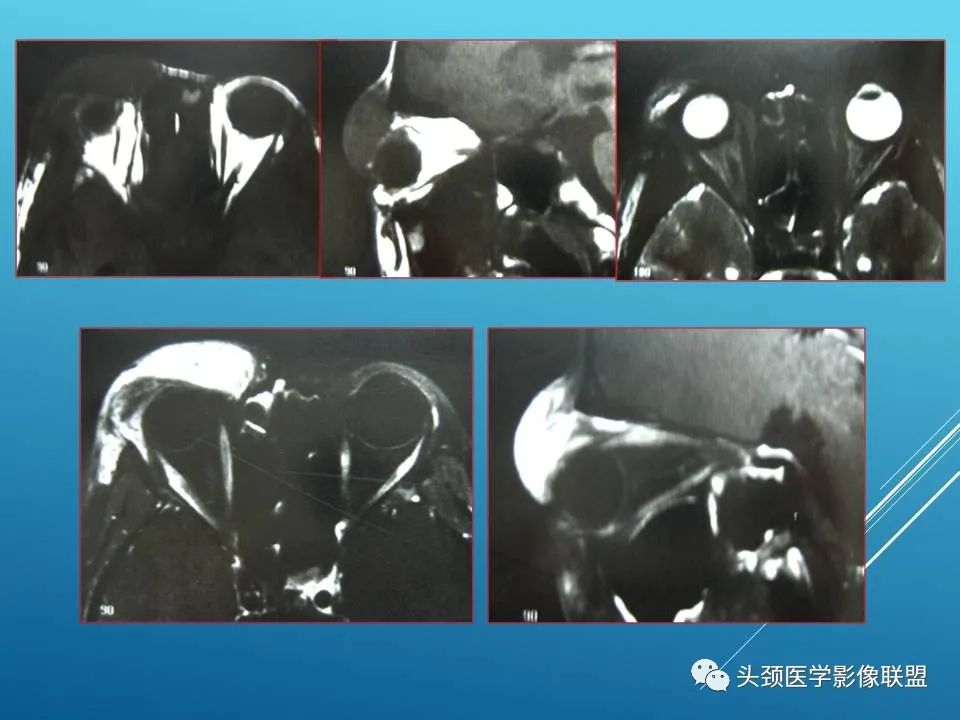 影像PPT - 【PPT】泪腺肿瘤及肿瘤样病变的影像学诊断-56
