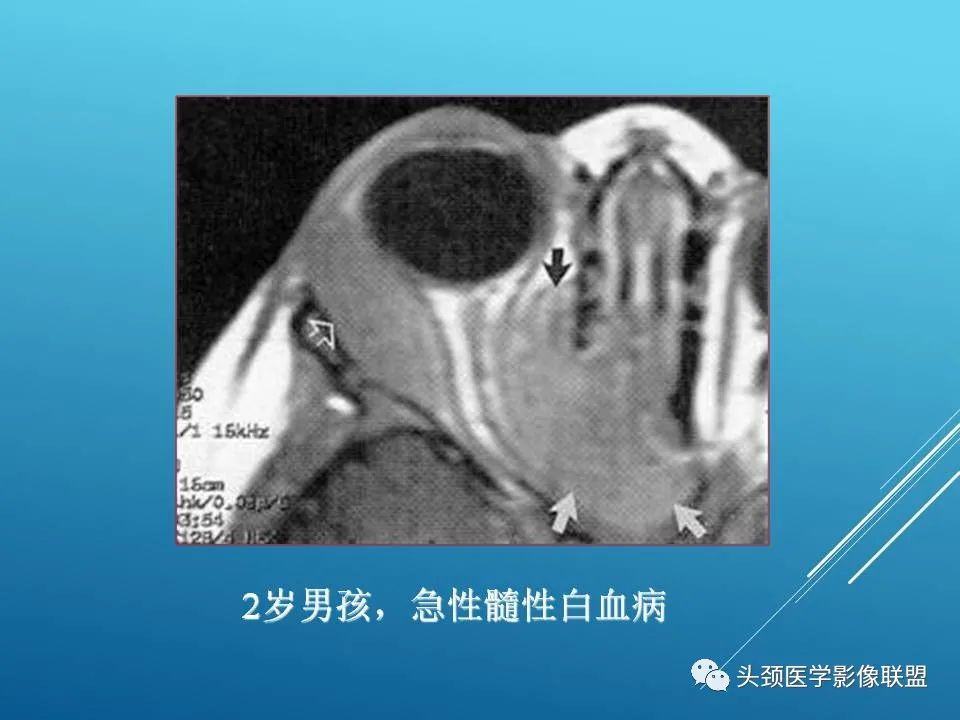 影像PPT - 【PPT】泪腺肿瘤及肿瘤样病变的影像学诊断-61