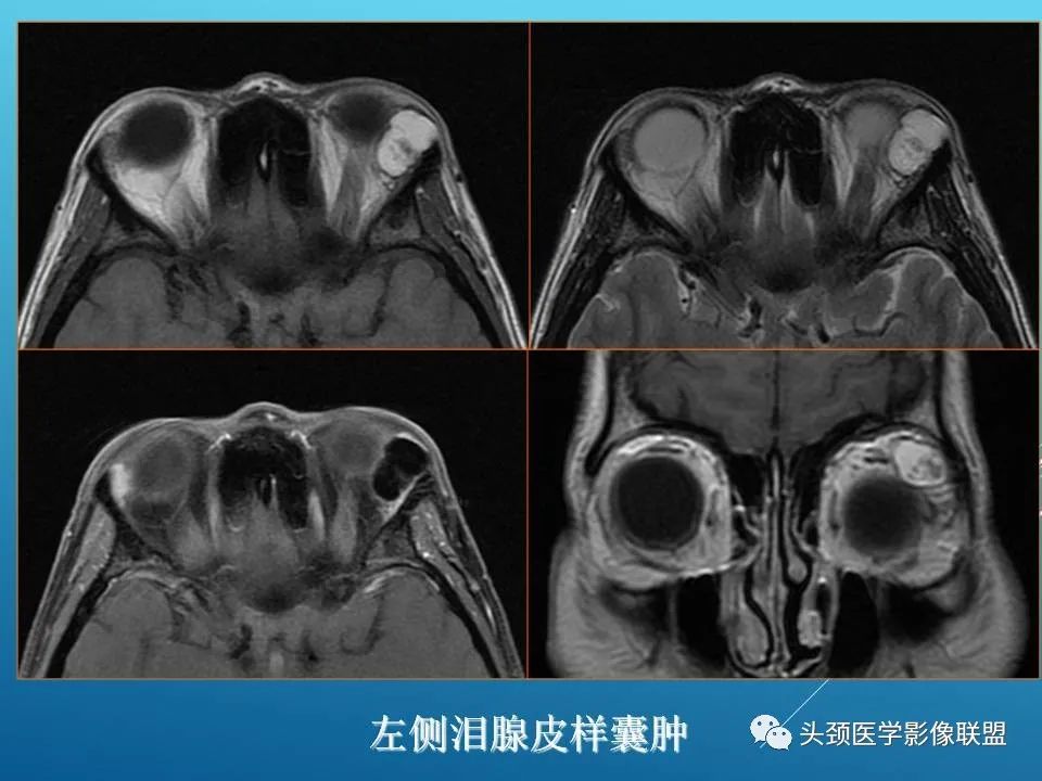 影像PPT - 【PPT】泪腺肿瘤及肿瘤样病变的影像学诊断-63