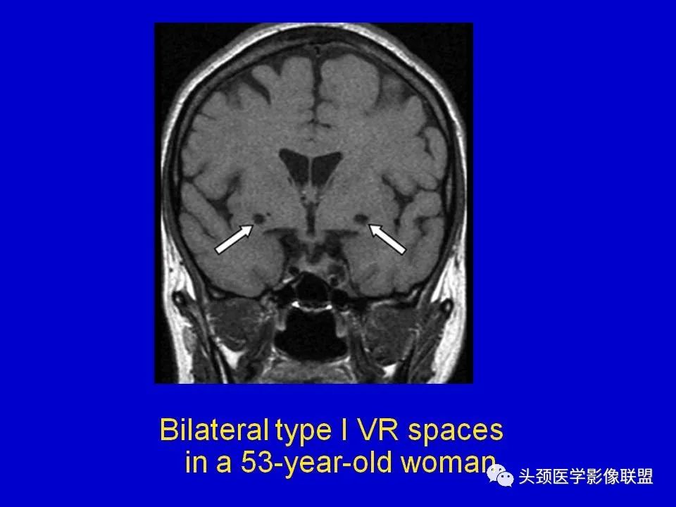 影像PPT - 【PPT】血管周围间隙的MR诊断及鉴别诊断-11