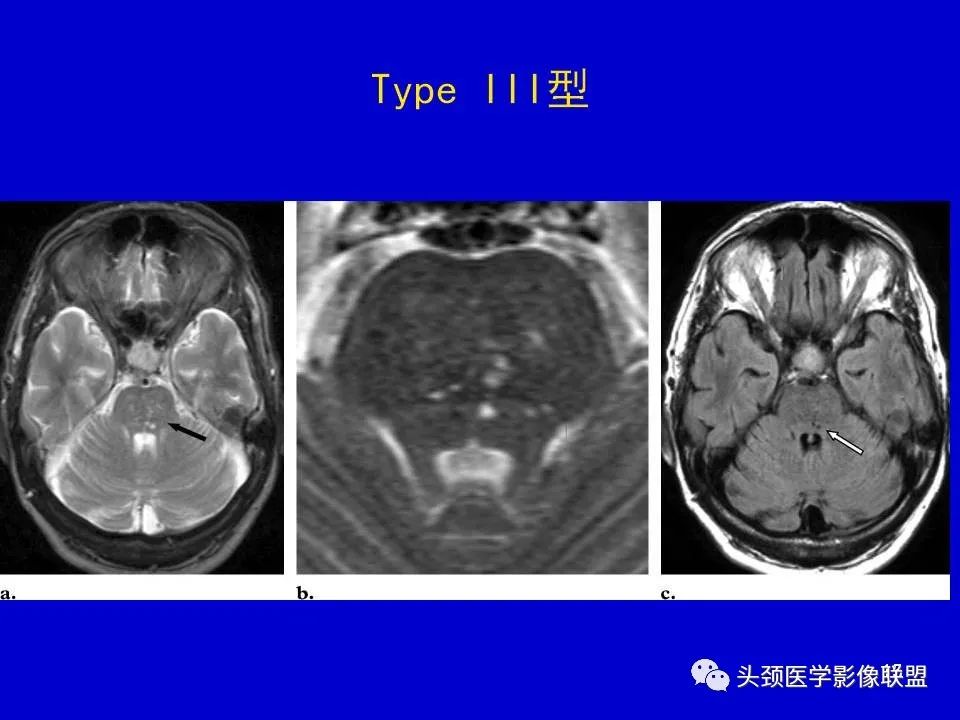 影像PPT - 【PPT】血管周围间隙的MR诊断及鉴别诊断-15