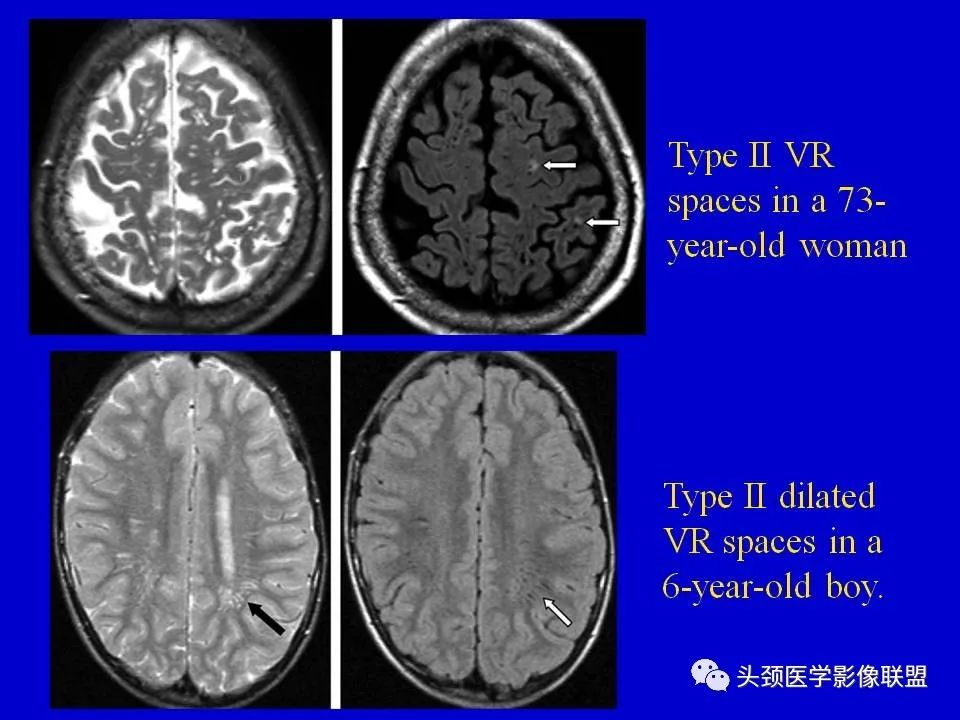 影像PPT - 【PPT】血管周围间隙的MR诊断及鉴别诊断-13
