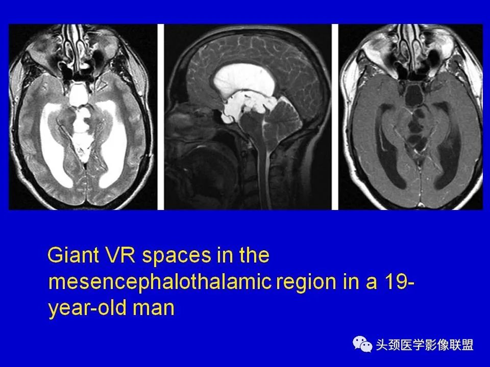 影像PPT - 【PPT】血管周围间隙的MR诊断及鉴别诊断-17