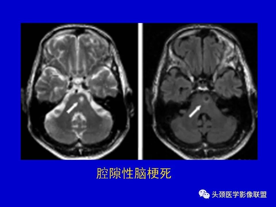 影像PPT - 【PPT】血管周围间隙的MR诊断及鉴别诊断-22
