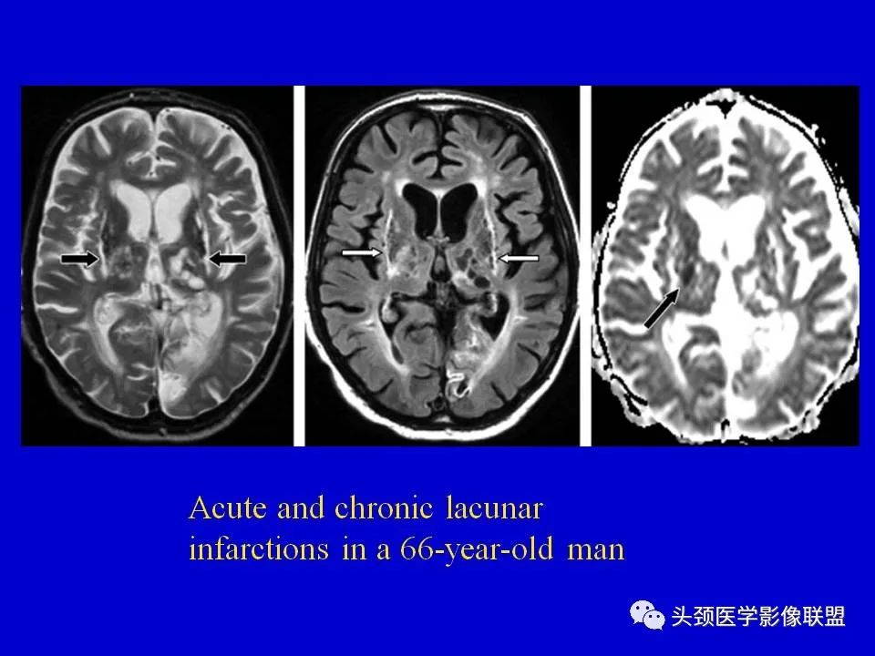 影像PPT - 【PPT】血管周围间隙的MR诊断及鉴别诊断-23