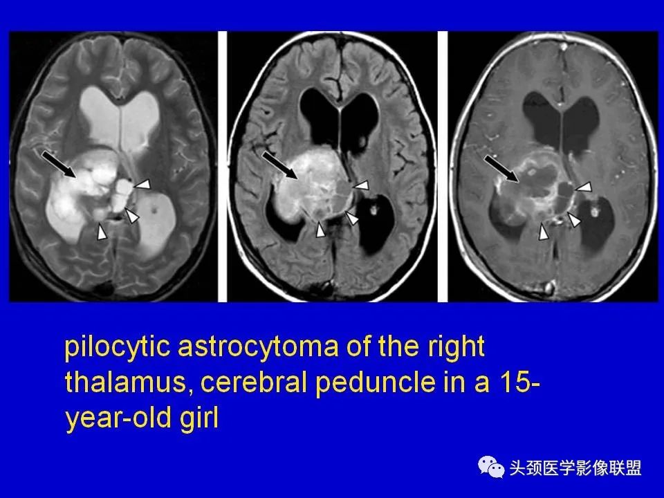 影像PPT - 【PPT】血管周围间隙的MR诊断及鉴别诊断-30