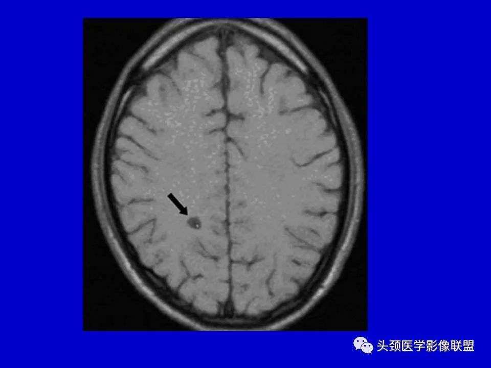 影像PPT - 【PPT】血管周围间隙的MR诊断及鉴别诊断-33