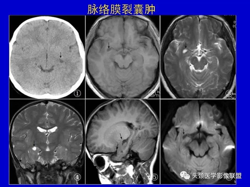 影像PPT - 【PPT】血管周围间隙的MR诊断及鉴别诊断-38