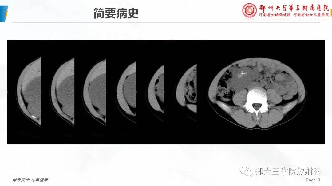 影像PPT - 【病例】腹膜后节细胞神经瘤1例影像分析-3