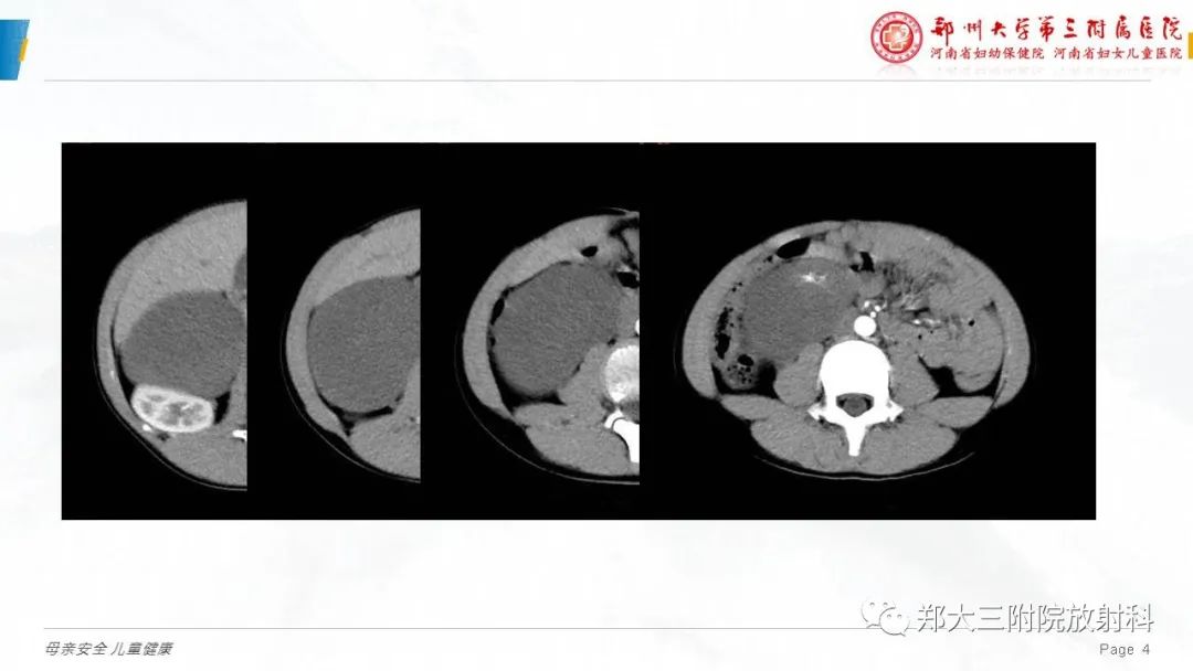 影像PPT - 【病例】腹膜后节细胞神经瘤1例影像分析-4