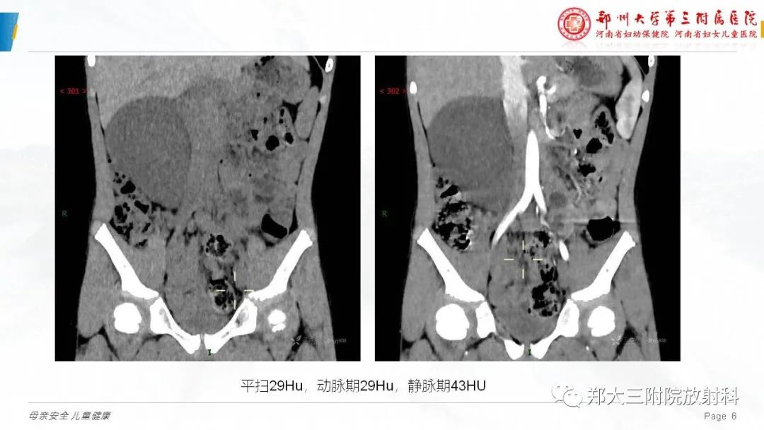 影像PPT - 【病例】腹膜后节细胞神经瘤1例影像分析-6