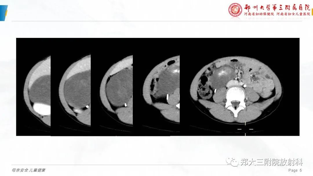 影像PPT - 【病例】腹膜后节细胞神经瘤1例影像分析-5