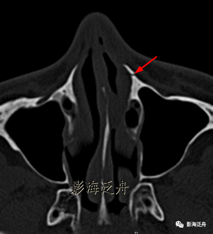 影像PPT - 鼻骨骨折的影像诊断-4