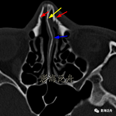 影像PPT - 鼻骨骨折的影像诊断-12