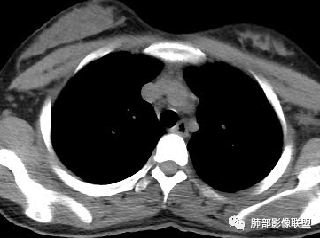 影像PPT - 【病例】水痘-带状疱疹病毒肺炎CT两例分析及文献学习-7 影像PPT - 【病例】水痘-带状疱疹病毒肺炎CT两例分析及文献学习-7