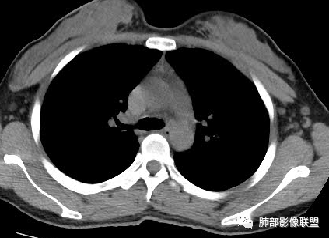 影像PPT - 【病例】水痘-带状疱疹病毒肺炎CT两例分析及文献学习-8 影像PPT - 【病例】水痘-带状疱疹病毒肺炎CT两例分析及文献学习-8