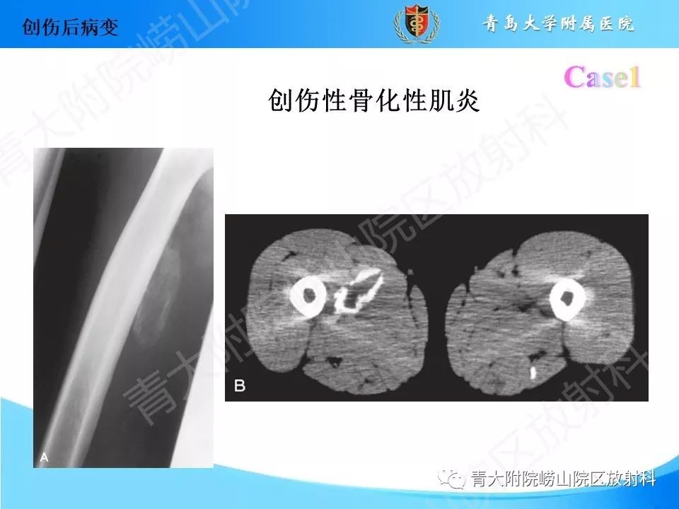 影像PPT - 【PPT】“不要碰”的骨关节病变-8