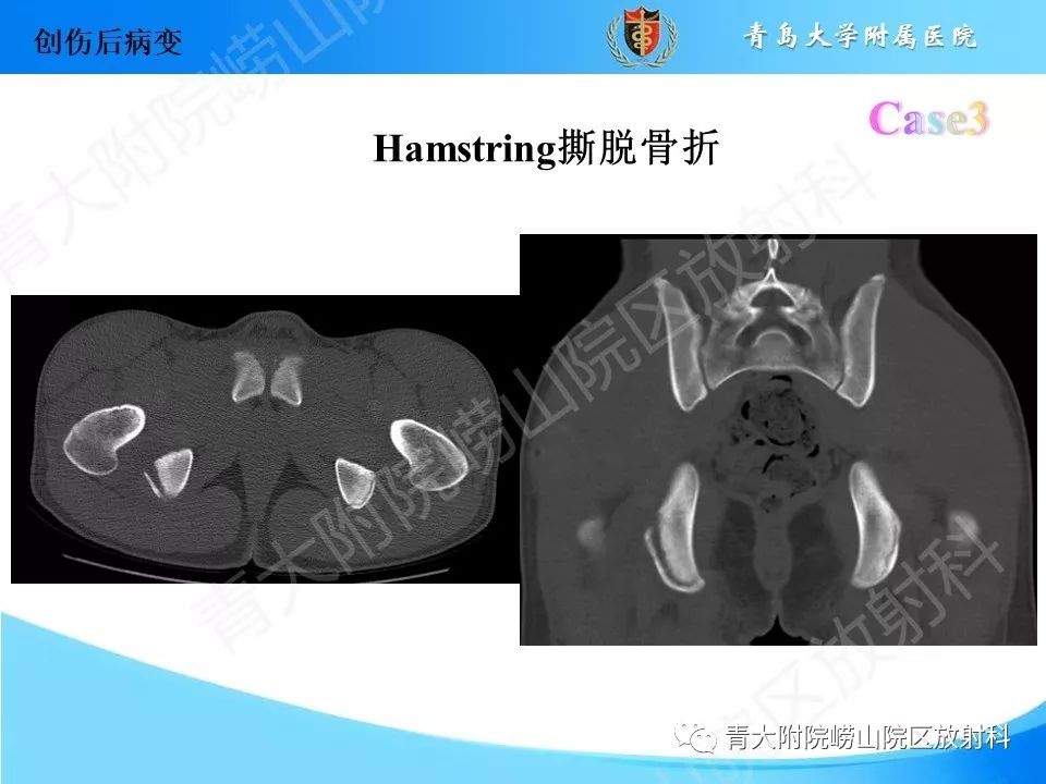 影像PPT - 【PPT】“不要碰”的骨关节病变-11