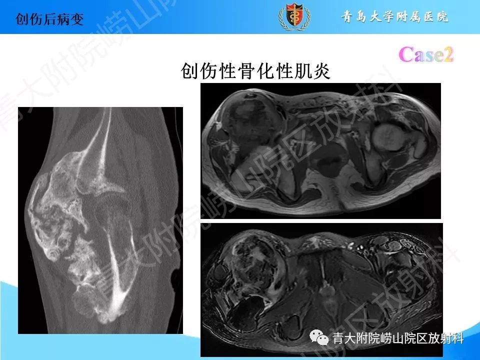 影像PPT - 【PPT】“不要碰”的骨关节病变-9