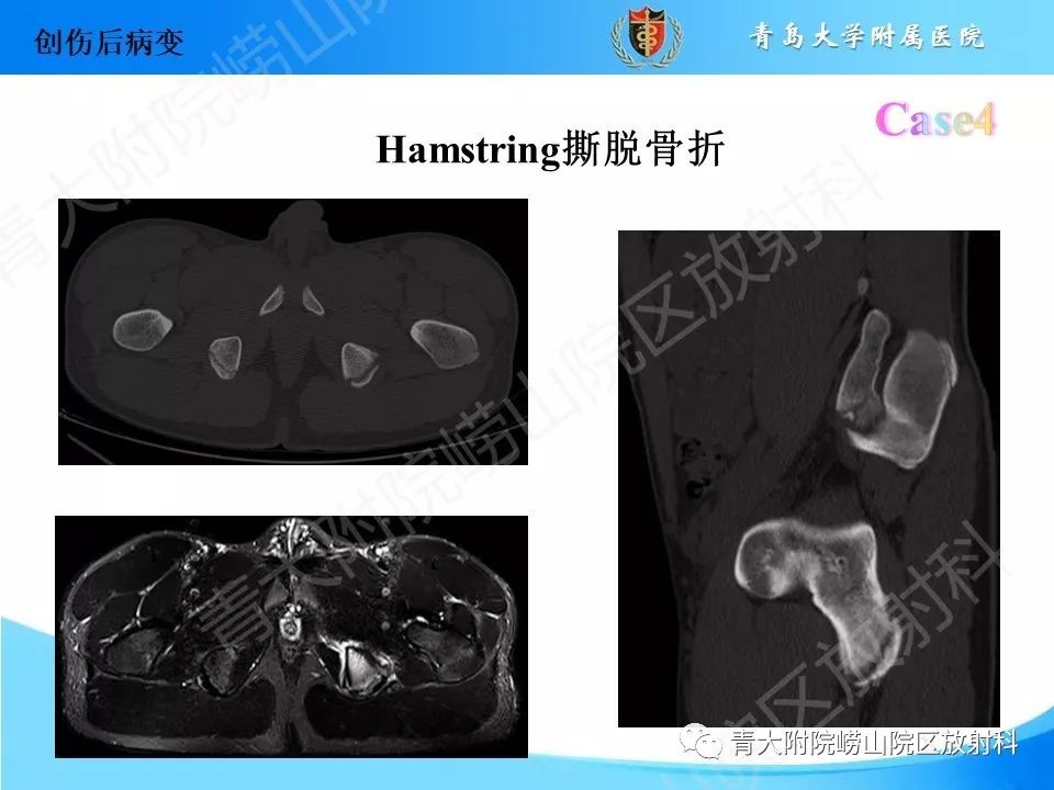 影像PPT - 【PPT】“不要碰”的骨关节病变-12
