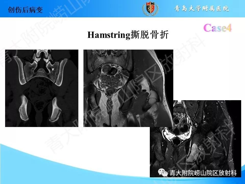 影像PPT - 【PPT】“不要碰”的骨关节病变-13