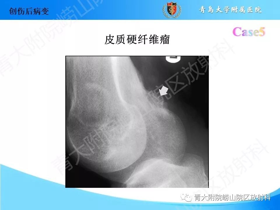 影像PPT - 【PPT】“不要碰”的骨关节病变-15