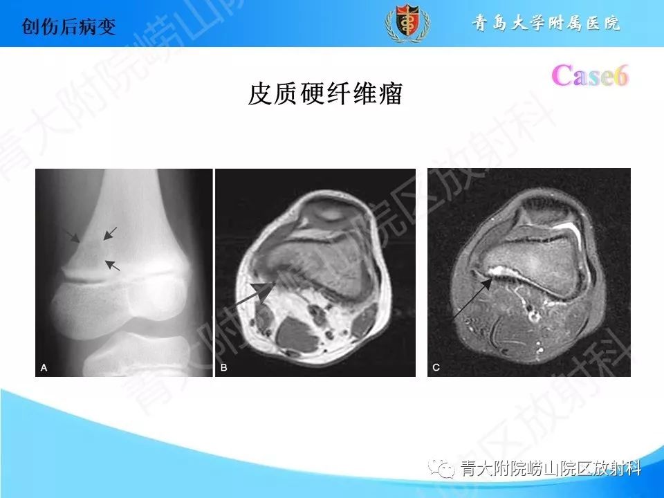 影像PPT - 【PPT】“不要碰”的骨关节病变-16