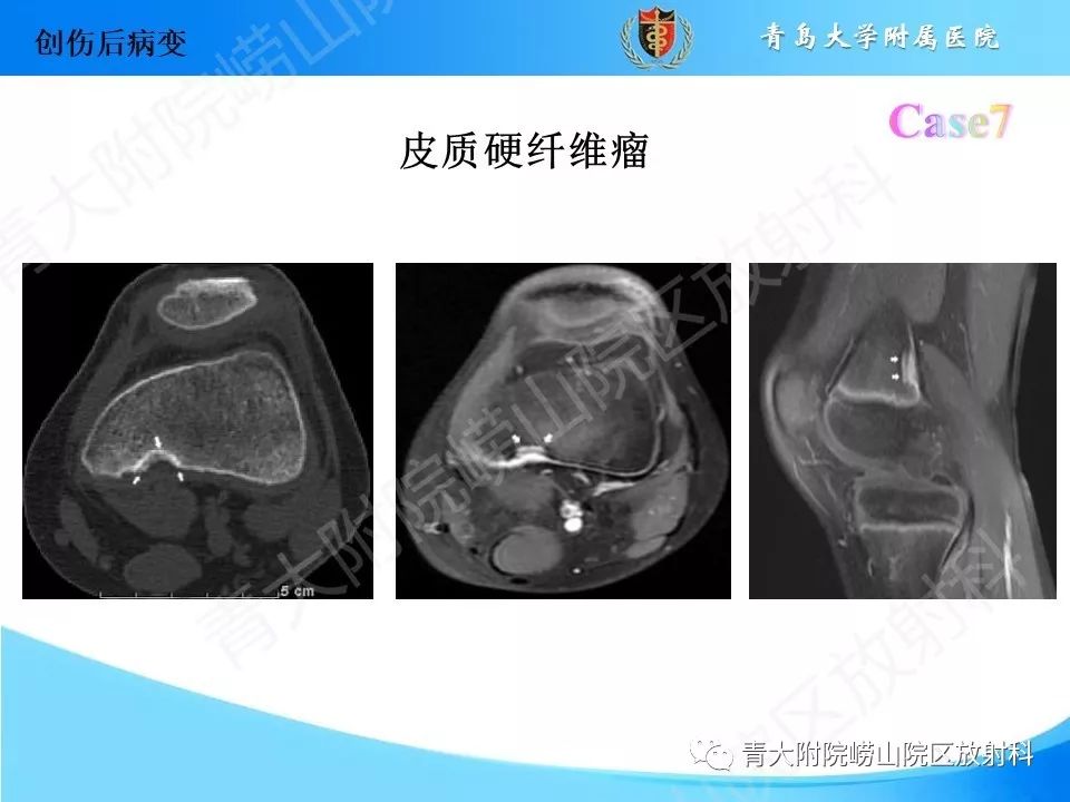 影像PPT - 【PPT】“不要碰”的骨关节病变-17