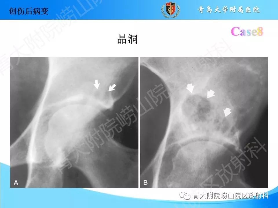影像PPT - 【PPT】“不要碰”的骨关节病变-19