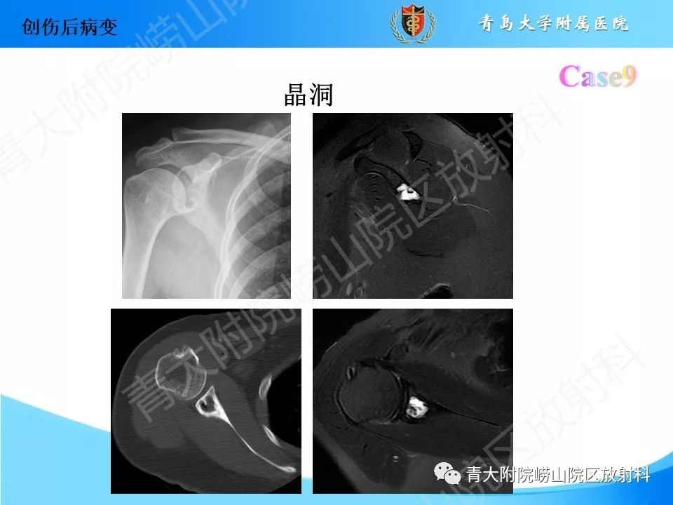 影像PPT - 【PPT】“不要碰”的骨关节病变-20