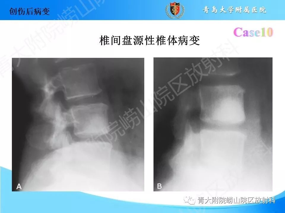 影像PPT - 【PPT】“不要碰”的骨关节病变-22