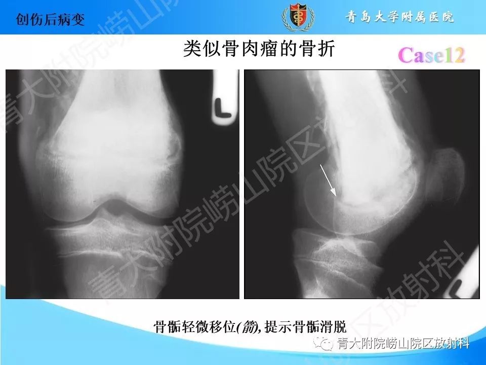 影像PPT - 【PPT】“不要碰”的骨关节病变-25