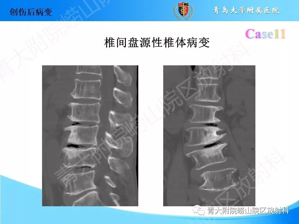 影像PPT - 【PPT】“不要碰”的骨关节病变-23