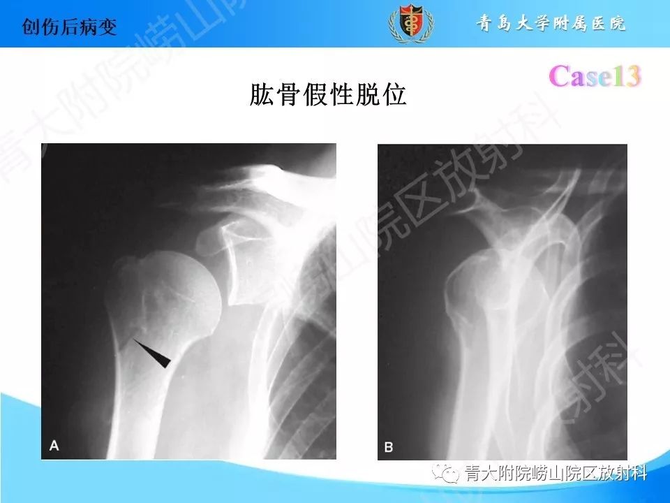 影像PPT - 【PPT】“不要碰”的骨关节病变-27