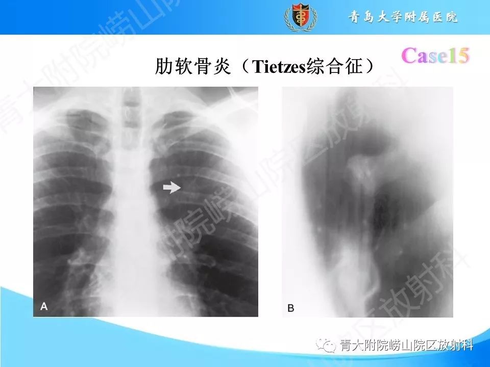 影像PPT - 【PPT】“不要碰”的骨关节病变-30
