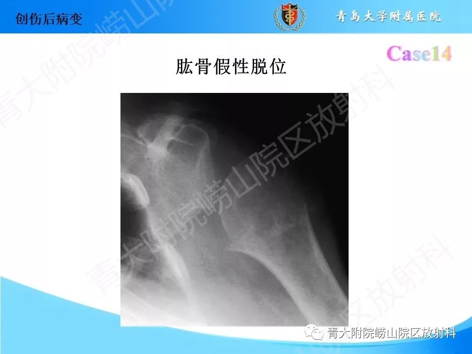 影像PPT - 【PPT】“不要碰”的骨关节病变-28