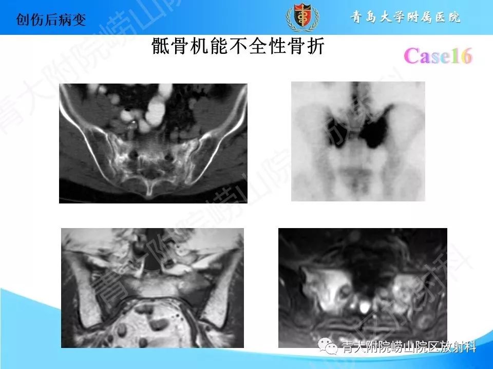 影像PPT - 【PPT】“不要碰”的骨关节病变-32