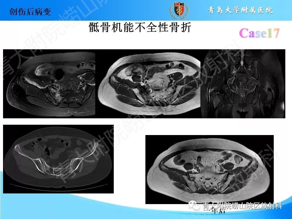 影像PPT - 【PPT】“不要碰”的骨关节病变-33