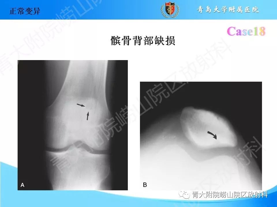 影像PPT - 【PPT】“不要碰”的骨关节病变-36