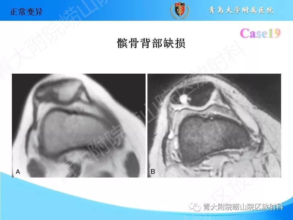 影像PPT - 【PPT】“不要碰”的骨关节病变-37