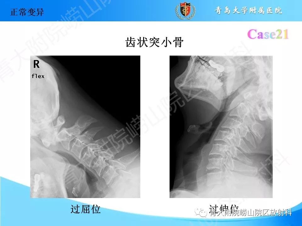 影像PPT - 【PPT】“不要碰”的骨关节病变-41
