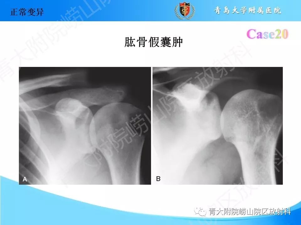 影像PPT - 【PPT】“不要碰”的骨关节病变-39