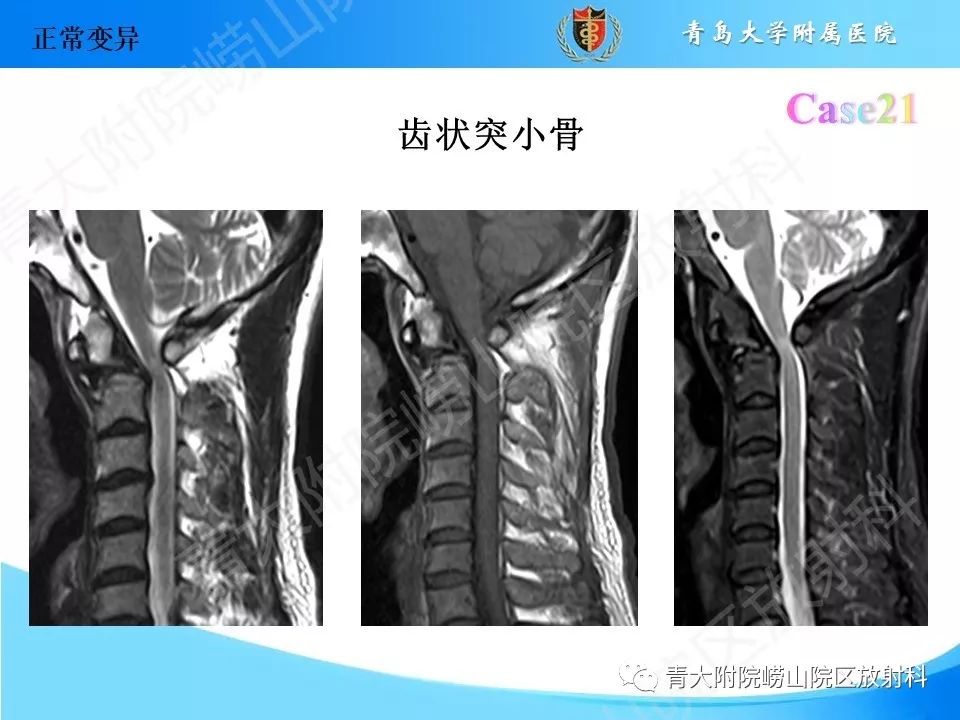 影像PPT - 【PPT】“不要碰”的骨关节病变-42
