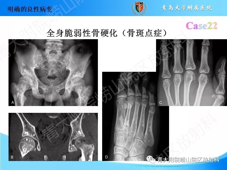 影像PPT - 【PPT】“不要碰”的骨关节病变-45