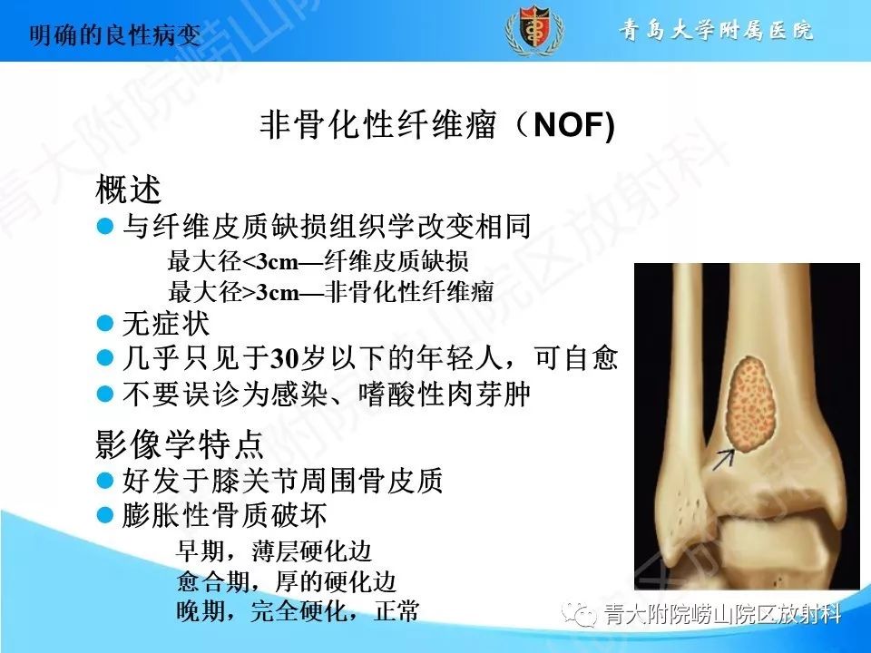影像PPT - 【PPT】“不要碰”的骨关节病变-46