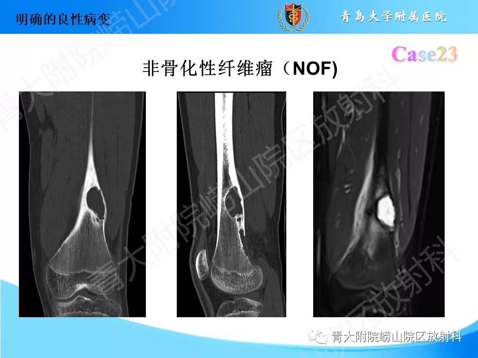 影像PPT - 【PPT】“不要碰”的骨关节病变-47