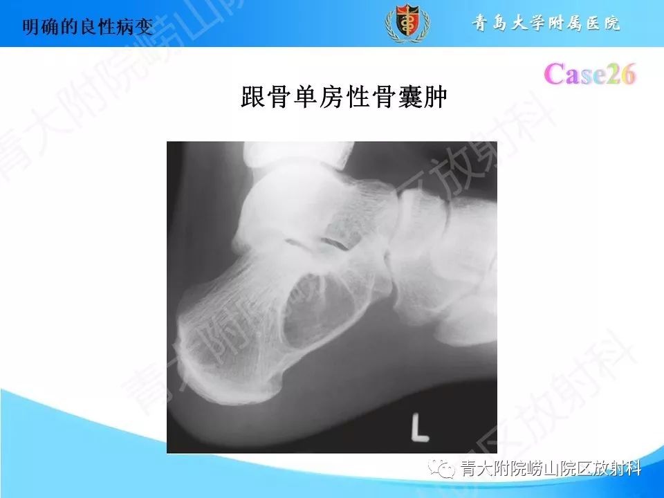 影像PPT - 【PPT】“不要碰”的骨关节病变-52