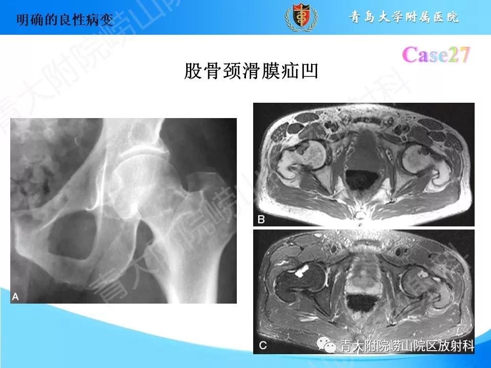影像PPT - 【PPT】“不要碰”的骨关节病变-54