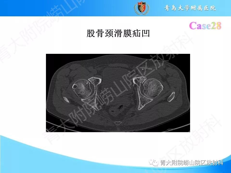 影像PPT - 【PPT】“不要碰”的骨关节病变-55